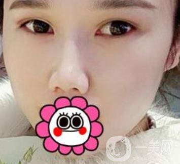 2020北京大學(xué)深圳醫(yī)院整形科價(jià)格表，附雙眼皮案例