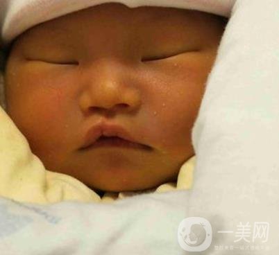 昆明醫(yī)科大學(xué)第一附屬醫(yī)院整形科價(jià)格表，內(nèi)附兔唇矯正案例