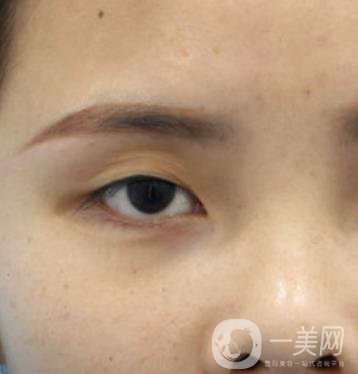 西安交通大學(xué)附屬醫(yī)院整形美容科價格表和雙眼皮案例一覽