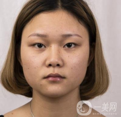 西安市中心醫(yī)院整形科價(jià)格表，內(nèi)附韓悅雙眼皮真人案例