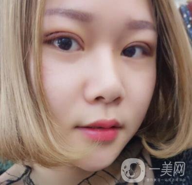 西安市中心醫(yī)院整形科價(jià)格表，內(nèi)附韓悅雙眼皮真人案例