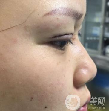 西安市中心醫(yī)院整形科價(jià)格表，內(nèi)附韓悅雙眼皮真人案例