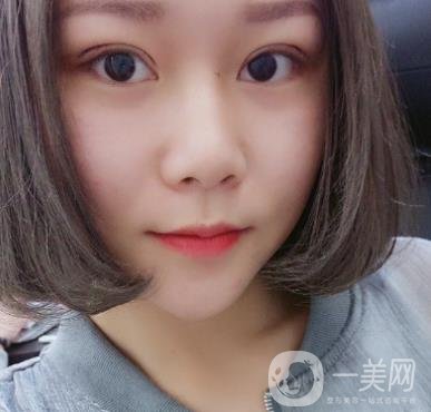 西安市中心醫(yī)院整形科價(jià)格表，內(nèi)附韓悅雙眼皮真人案例