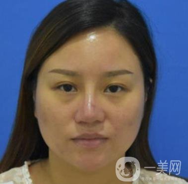 張掖市人民醫(yī)院美容整形科價格表，附眼袋切除*果圖