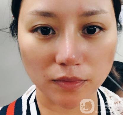 張掖市人民醫(yī)院美容整形科價格表，附眼袋切除*果圖