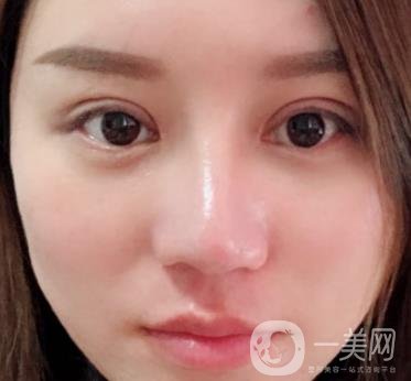 張掖市人民醫(yī)院美容整形科價格表，附眼袋切除*果圖