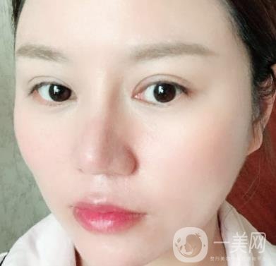 張掖市人民醫(yī)院美容整形科價格表，附眼袋切除*果圖