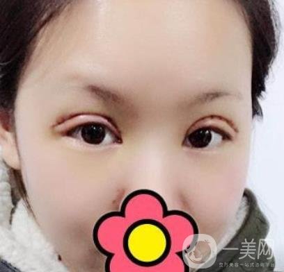 甘肅省人民醫(yī)院割雙眼皮怎么樣？附整形價(jià)格表及真人案例