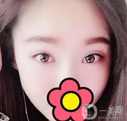甘肅省人民醫(yī)院割雙眼皮怎么樣？附整形價(jià)格表及真人案例
