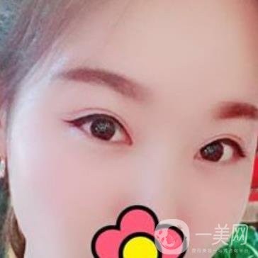 甘肅省人民醫(yī)院割雙眼皮怎么樣？附整形價(jià)格表及真人案例