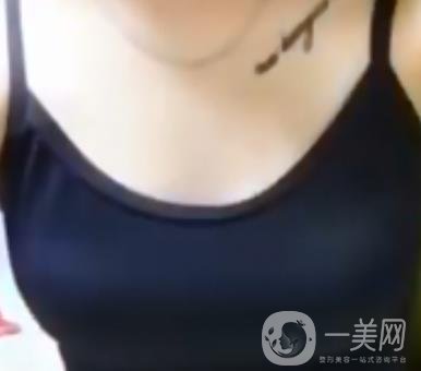 廣東省第二人民醫(yī)院隆胸手術(shù)多少錢？羅盛康案例？附整形價格表