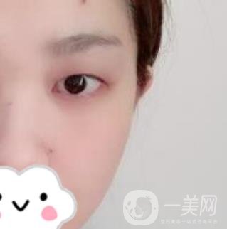 湖南省人民醫(yī)院割雙眼皮要多少錢(qián)？整形價(jià)格表一覽