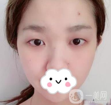 湖南省人民醫(yī)院割雙眼皮要多少錢(qián)？整形價(jià)格表一覽