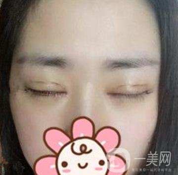 秦皇島人民醫(yī)院雙眼皮怎么樣？附整形價格表及案例圖