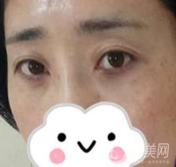 第九人民醫(yī)院去眼袋