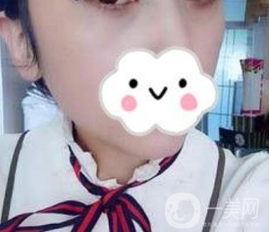 第九人民醫(yī)院去眼袋