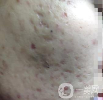 綿陽(yáng)中心醫(yī)院整形美容科祛痘坑怎么樣？?jī)r(jià)格表及術(shù)后*果分享