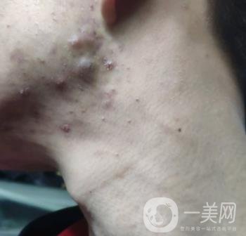 綿陽(yáng)中心醫(yī)院整形美容科祛痘坑怎么樣？?jī)r(jià)格表及術(shù)后*果分享