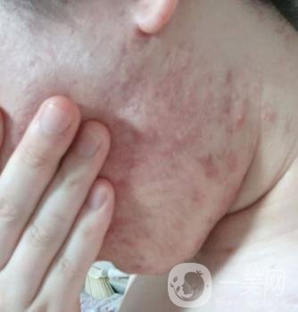 綿陽(yáng)中心醫(yī)院整形美容科祛痘坑怎么樣？?jī)r(jià)格表及術(shù)后*果分享