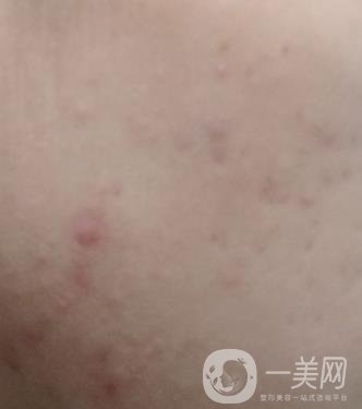 綿陽(yáng)中心醫(yī)院整形美容科祛痘坑怎么樣？?jī)r(jià)格表及術(shù)后*果分享