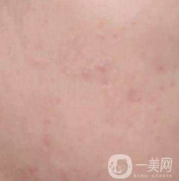 綿陽(yáng)中心醫(yī)院整形美容科祛痘坑怎么樣？?jī)r(jià)格表及術(shù)后*果分享