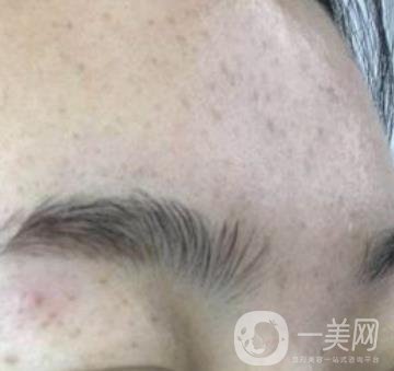 南京省中醫(yī)院整形美容科祛黃褐斑多少錢？價格表及案例詳情一覽