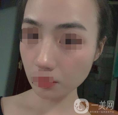 南京省中醫(yī)院整形美容科祛黃褐斑多少錢？價格表及案例詳情一覽