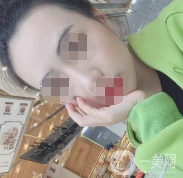 南京省中醫(yī)院整形美容科祛黃褐斑多少錢？價格表及案例詳情一覽