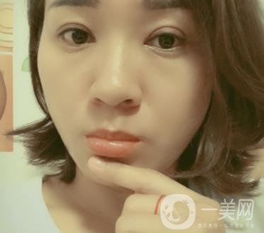 中山一院整形科價格表,及切腋臭日記一覽