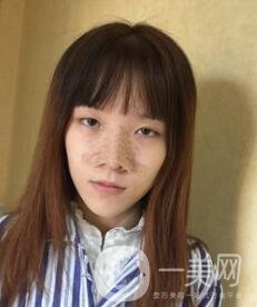 南昌二附院整形科價格表2020，附肋軟骨隆鼻整形案例