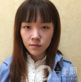 南昌二附院整形科價格表2020，附肋軟骨隆鼻整形案例