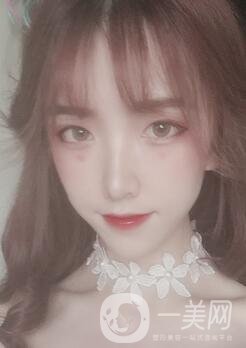 南昌二附院整形科價格表2020，附肋軟骨隆鼻整形案例