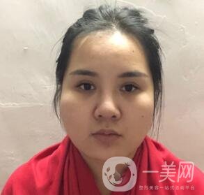 景德鎮(zhèn)第一人民醫(yī)院整形科價格表，附面部吸脂瘦臉案例