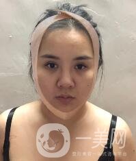 景德鎮(zhèn)第一人民醫(yī)院整形科價格表，附面部吸脂瘦臉案例