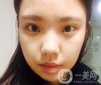 西安唐都醫(yī)院價格表價目表，內附吳瓊隆鼻整形日記