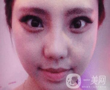 西安唐都醫(yī)院價格表價目表，內附吳瓊隆鼻整形日記