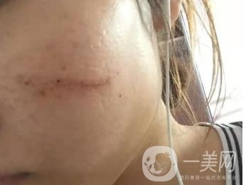 西安市中心醫(yī)院整形科價目價格一覽，附陶諫祛疤案例*果圖