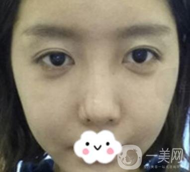 泉州二院整形外科可以打玻尿酸嗎？附價(jià)格表及玻尿酸隆鼻案例