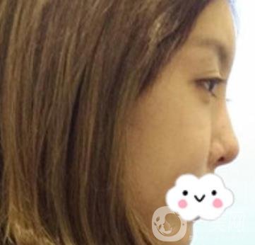 泉州二院整形外科可以打玻尿酸嗎？附價(jià)格表及玻尿酸隆鼻案例