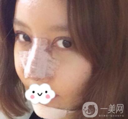 泉州二院整形外科可以打玻尿酸嗎？附價(jià)格表及玻尿酸隆鼻案例