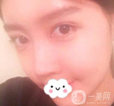 泉州二院整形外科可以打玻尿酸嗎？附價(jià)格表及玻尿酸隆鼻案例