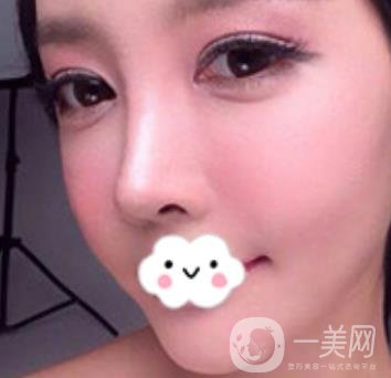 泉州二院整形外科可以打玻尿酸嗎？附價(jià)格表及玻尿酸隆鼻案例