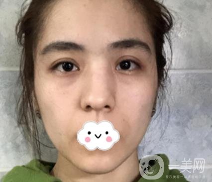 上海伯思立整形怎么樣？附沈國雄隆鼻案例及整形價格表