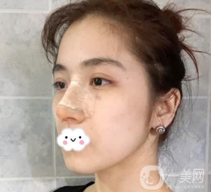 上海伯思立整形怎么樣？附沈國雄隆鼻案例及整形價格表