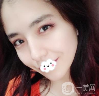 上海伯思立整形怎么樣？附沈國雄隆鼻案例及整形價格表