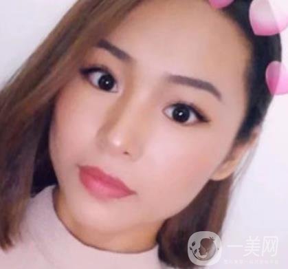 上海九院切下頜角手術經歷分享，附2020整形價格一覽表