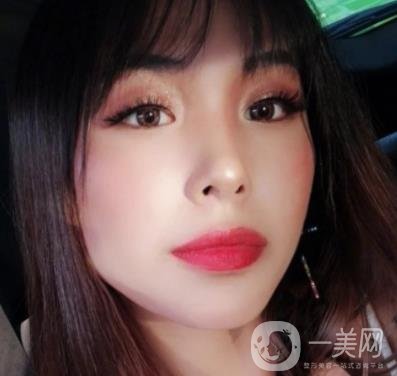 上海九院切下頜角手術經歷分享，附2020整形價格一覽表