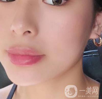 上海九院切下頜角手術經歷分享，附2020整形價格一覽表