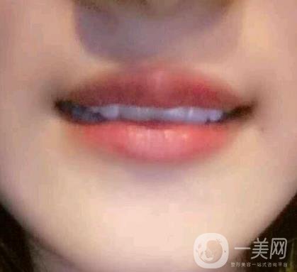 北京市海淀醫(yī)院整牙多少錢？看價(jià)格表及案例*果