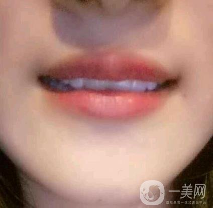 北京市海淀醫(yī)院整牙多少錢？看價(jià)格表及案例*果